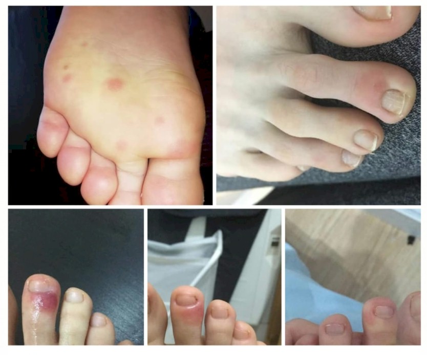 新冠狀病毒感染者會在腳上出現紅斑或褐斑